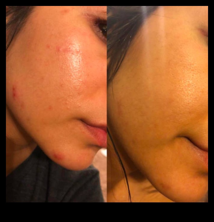 Πούδρα και ακμή: Πώς να ελέγξετε τη λάμψη χωρίς επιδείνωση των κηλίδων