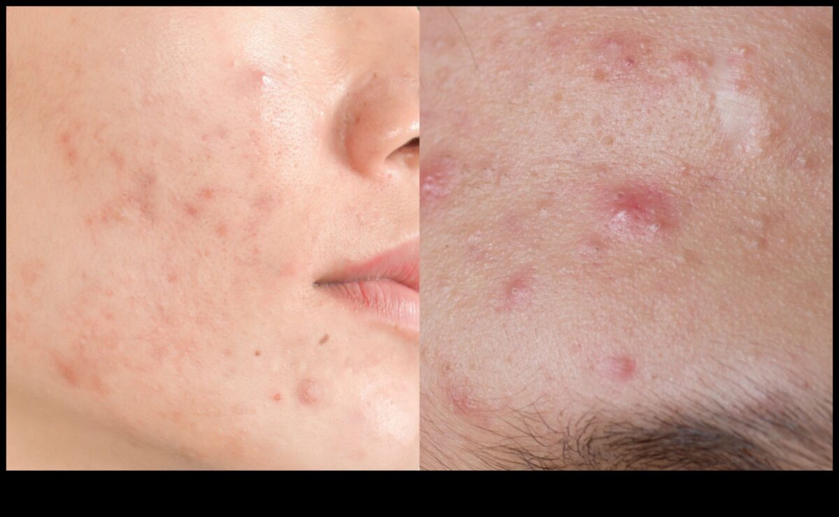 Πούδρα και ακμή: Πώς να ελέγξετε τη λάμψη χωρίς επιδείνωση των κηλίδων