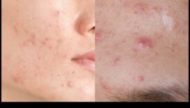 Πούδρα και σπυράκια Ένας κινητήρια δύναμη για τον έλεγχο της λάμψης με έξω επιβαρυντικές κηλίδες 2 Πούδρα και ακμή: Πώς να ελέγξετε τη λάμψη χωρίς επιδείνωση των κηλίδων