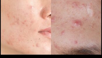 Πούδρα και ακμή: Πώς να ελέγξετε τη λάμψη χωρίς επιδείνωση των κηλίδων